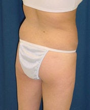 Brazilian Butt Lift before 635107