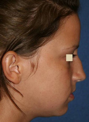 Rhinoplasty before 142567