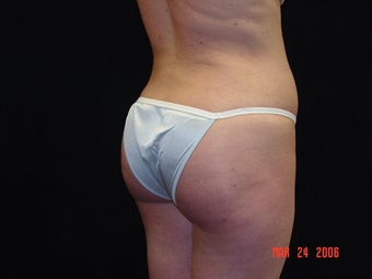 Brazilian Buttocks Lift after 145513