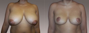 Breast Reduction before 395519