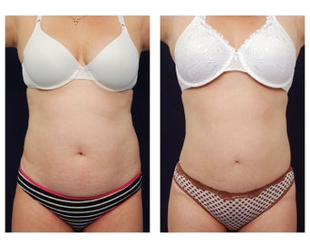 Liposuction before 391783