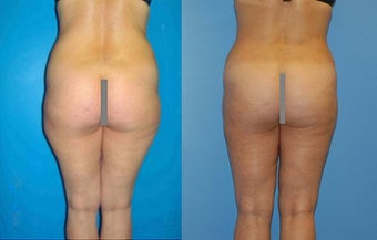 Abdominoplasty before 356617