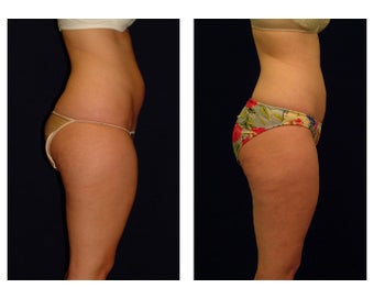 Liposuction before 286706