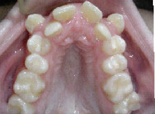 Damon Braces before 379871
