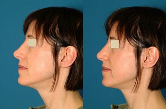 Non Surgical Rhinoplasty before 117307