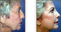 Facelift with Rhinoplasty before 88842