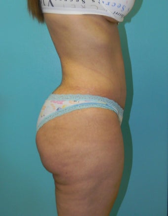 Brazilian Butt Lift- Fat transfer after 372611