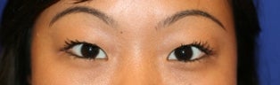 Asian Double Eyelid Surgery before 507305