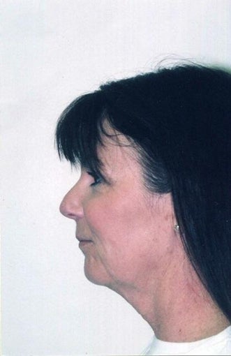 Neck Lift before 215150