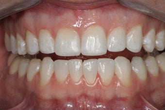 Whitening and Bonding after 112131