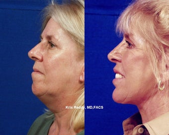 Restylane with Facelift, Rhinoplasty, and Laser Resurfacing before 545115