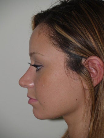 Rhinoplasty after 519756