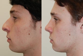 Rhinoplasty Surgery. 1 month post-op. before 279978