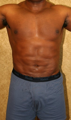 liposuction of abdomen and flanks of man from Los Angeles after 583370