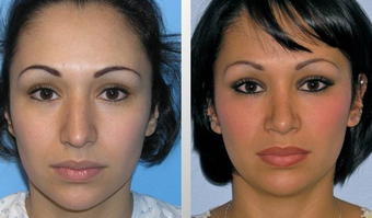 Rhinoplasty before 163634