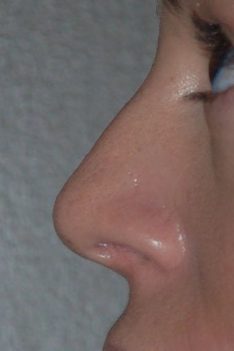 Rhinoplasty after 271669