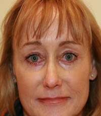 blepharoplasty (eyelids) after 219335