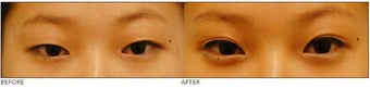 Asian Blepharoplasty ("Double Eyelid" Procedure) before 136814