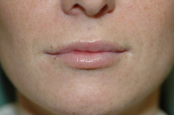 Lip augmentation after 340189