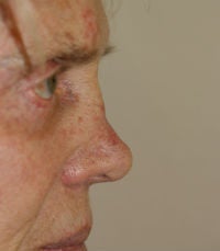 Revision rhinoplasty before 380426