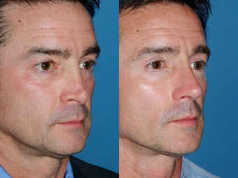 Revision rhinoplasty 334286