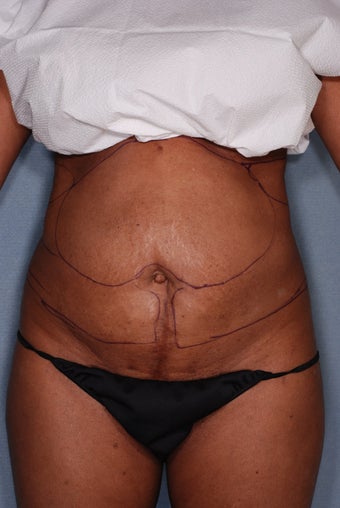 SmartLipo before 356692