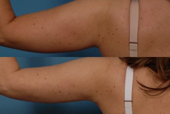 Smartlipo after 409387