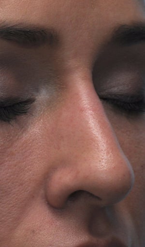 Non Surgical Rhinoplasty 407867