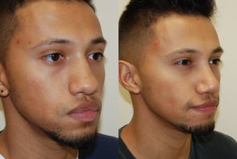 Rhinoplasty Surgery. 1 month post-op. before 606404
