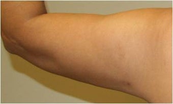 SmartLipo Arm - Left Before after 109324