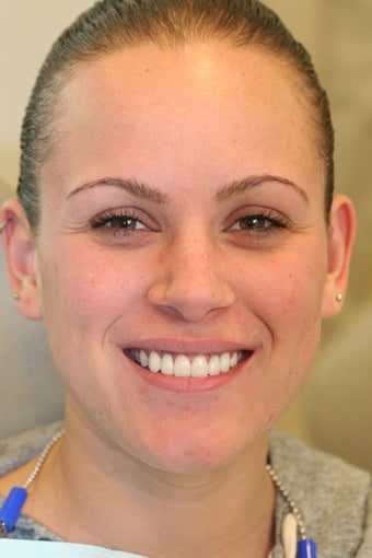 veneer and crown correction after 558814