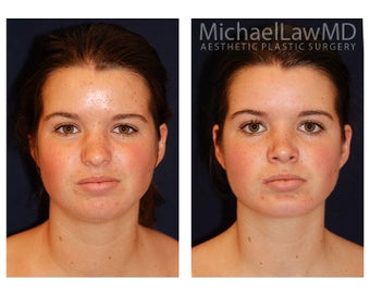 Chin Liposuction before 494435