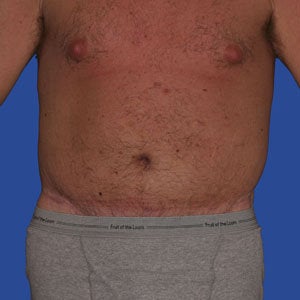 Abdominoplasty after 254382