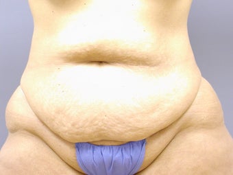 Abdominoplasty with Power-Assisted liposuction before 512232