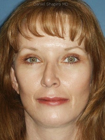 Facelift, Anterior Hairline Browlift, Bilateral Lower Blepharoplasty, Chin Augmentation with placement of extended chin implant, after 249144