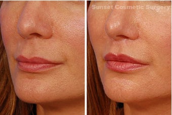 Lip lift after 355955