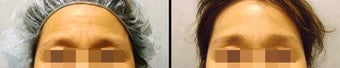 Endoscopic Brow Lift before 649387