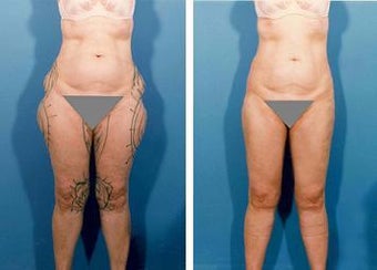 Liposuction before 636217