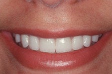 Porcelain Veneers after 379804