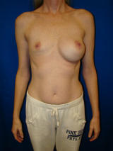 Revisionary Breast Surgery before 119394