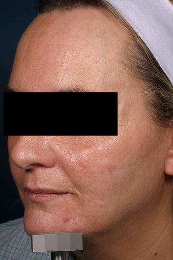 Fraxel - acne scars before 136194