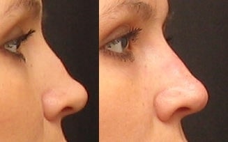Non Surgical Nose Job before 261549