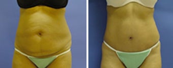 Tummy Tuck with liposuction before 8963