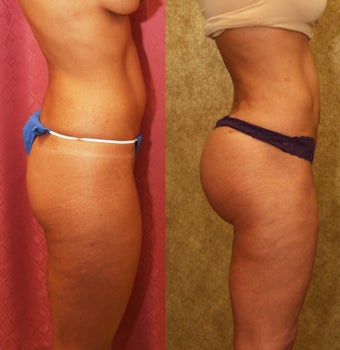 Brazilian buttock augmentation with fat grafting to the buttocks with liposuction in Los Angeles after 583430
