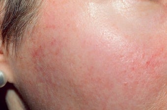 Chemical peel before 374258