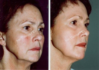 Non-Surgical Face Lift- Exoderm before 243001