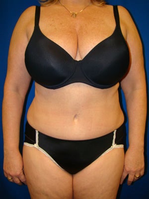 Tummy Tuck Surgery (Abdominoplasty) after 161996