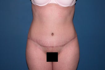 Tummy tuck with liposuction of the flanks after 247948