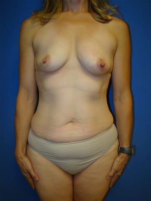 Extended Tummy Tuck (abdominoplasty) with Breast Augmentation Surgery before 127264
