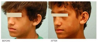 Otoplasty (Cosmetic Ear Pinning) before 136401